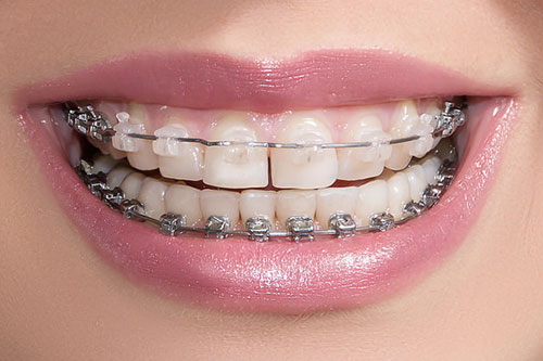 clear braces