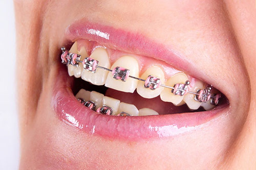 metal braces